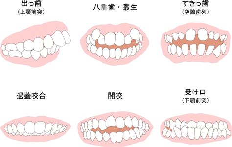 方形矯正線作用|不正咬合の原因と矯正治療